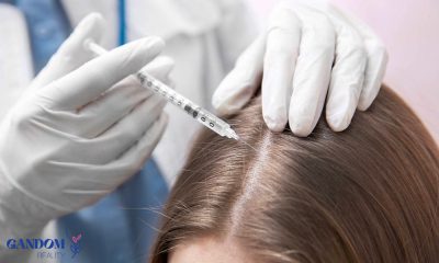 مزوتراپی مو چیست؟ مزایا، عوارض و هزینه درمان ریزش مو با مزوتراپی
