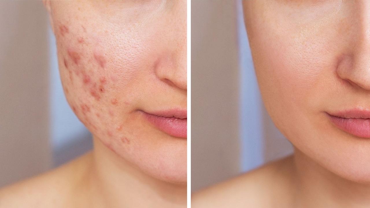 بهترین روشهای درمان جای جوش